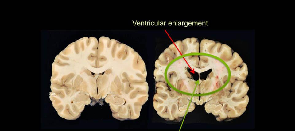 CTE Brain